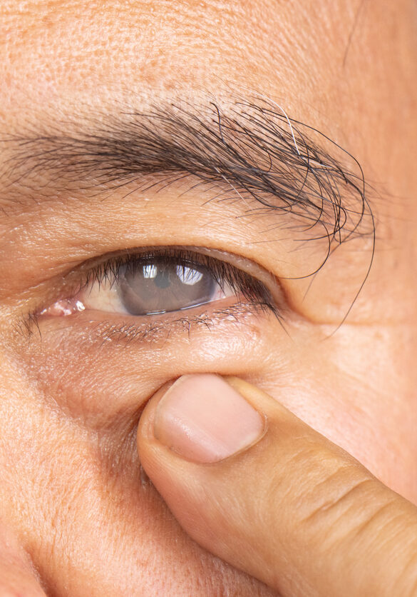 Senior man has cataract. Generally, cataracts are common in older people.